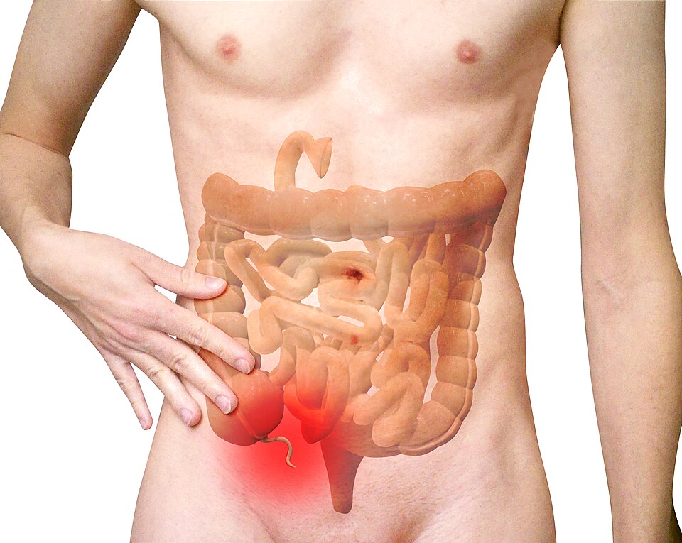 Appendix Surgery -Appendicitis and Emergency Surgical Care