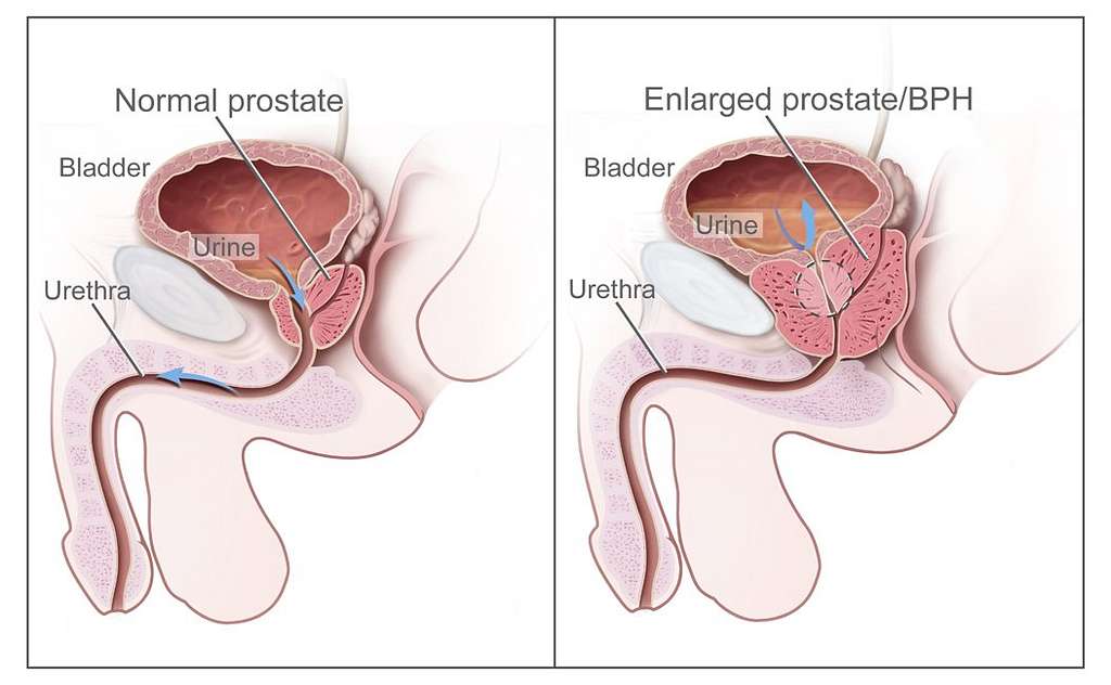 Prostate Health and Surgery Options